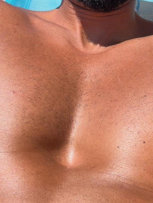 Pecho con pectus excavatum antes de empezar